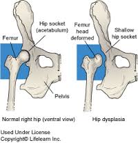 Dysplasia