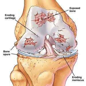 a láb reumás ízületi gyulladása hogyan kell kezelni akut térdfájdalom éjjel
