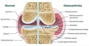 Kutya ízületi gyulladás összehasonlítása: egészséges és osteoarthritisben érintett ízület szerkezete, porc- és ízületi folyadék elváltozásokkal.